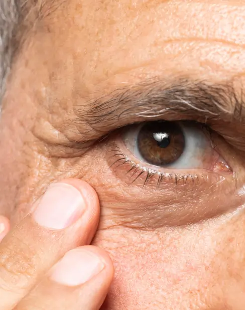 Symptoms Wet Macular Degeneration